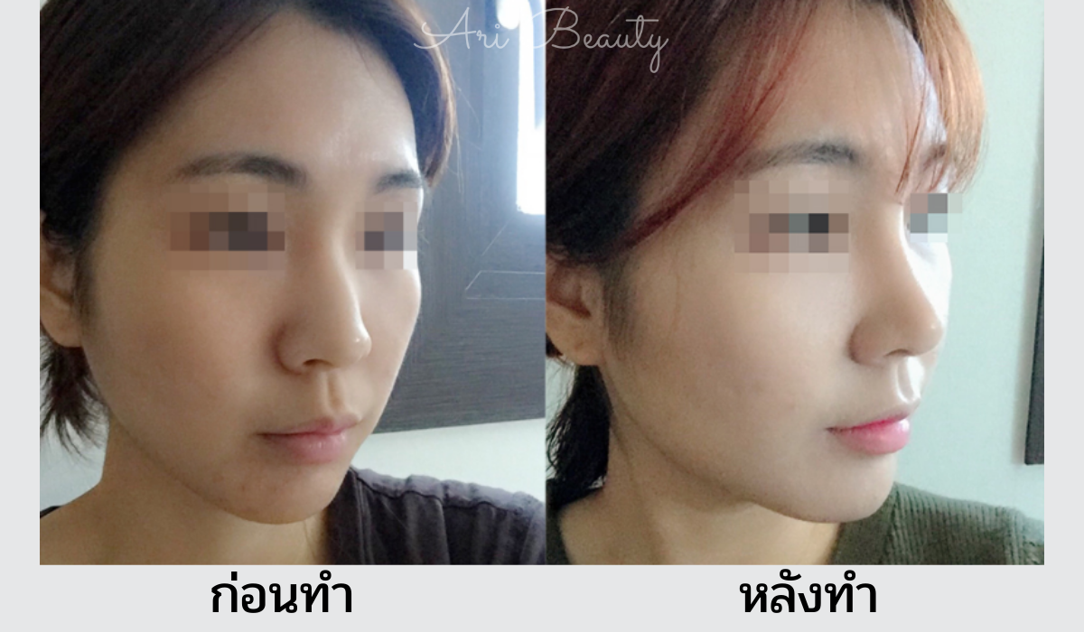 รีวิวจริงโรงพยาบาลศัลยกรรมพรีเมียร์